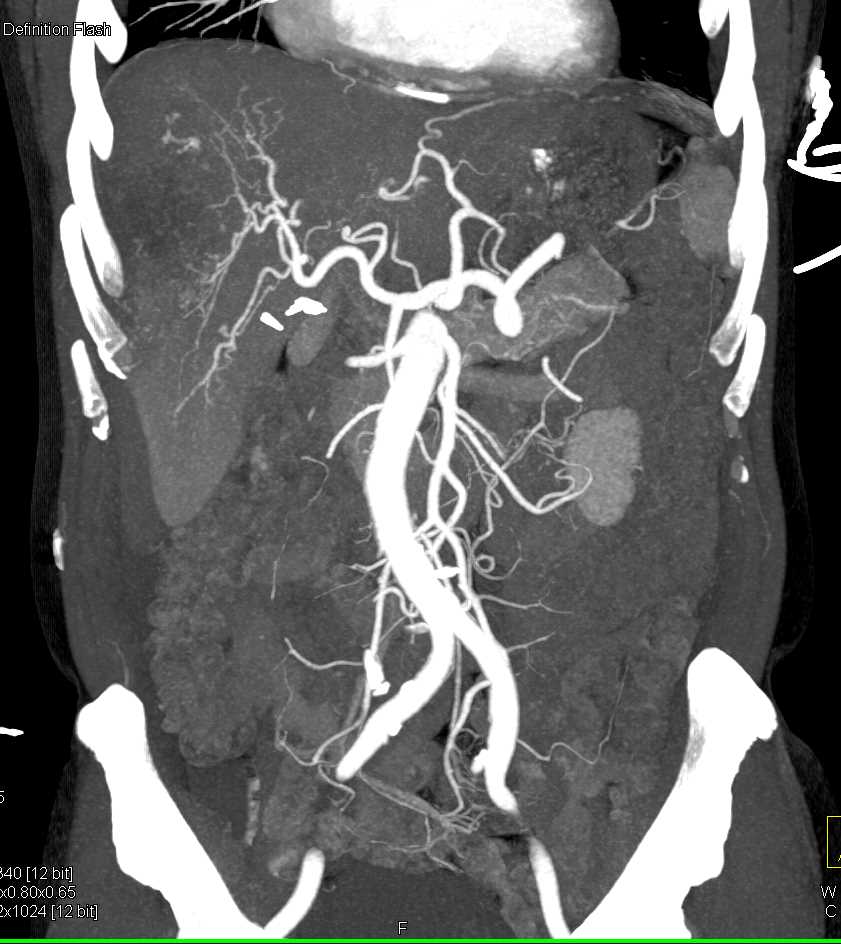 Carcinoma Gastroesophageal (GE) Junction with Metastases - CTisus CT Scan