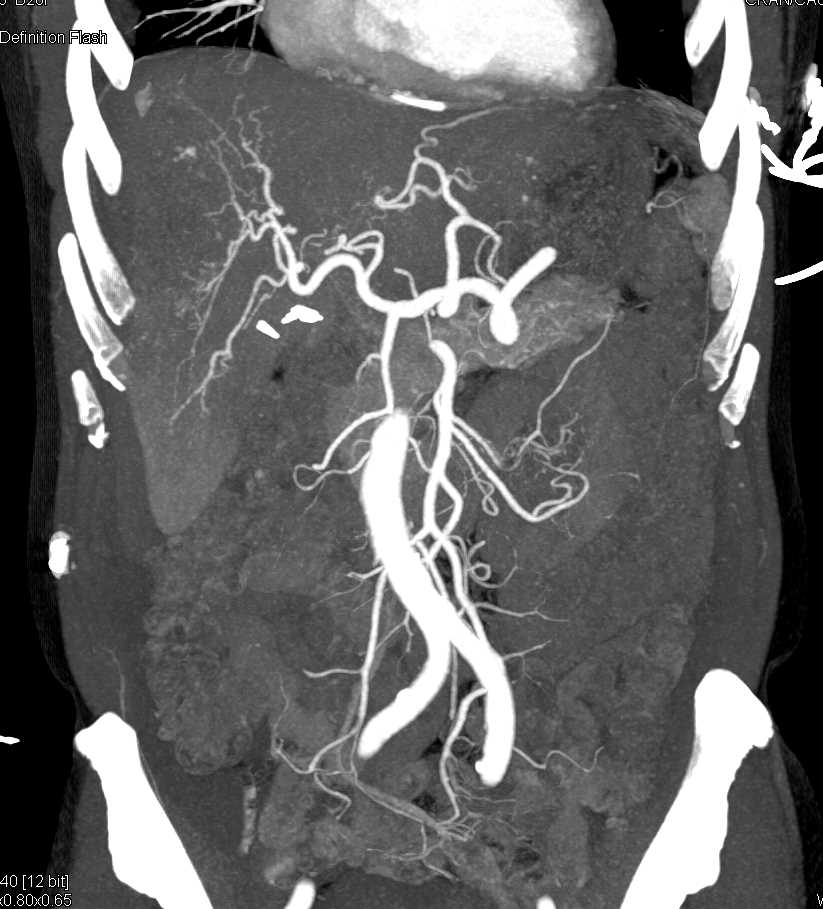 Carcinoma GE Junction with Metastases - CTisus CT Scan