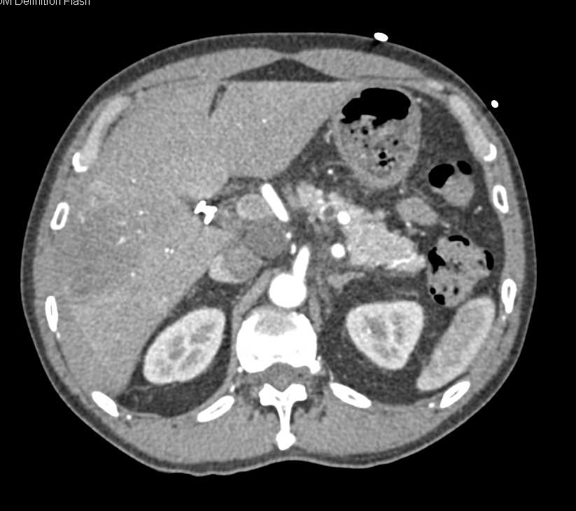 Carcinoma GE Junction with Metastases - CTisus CT Scan