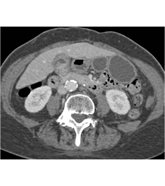 Gallbladder Cancer - CTisus CT Scan