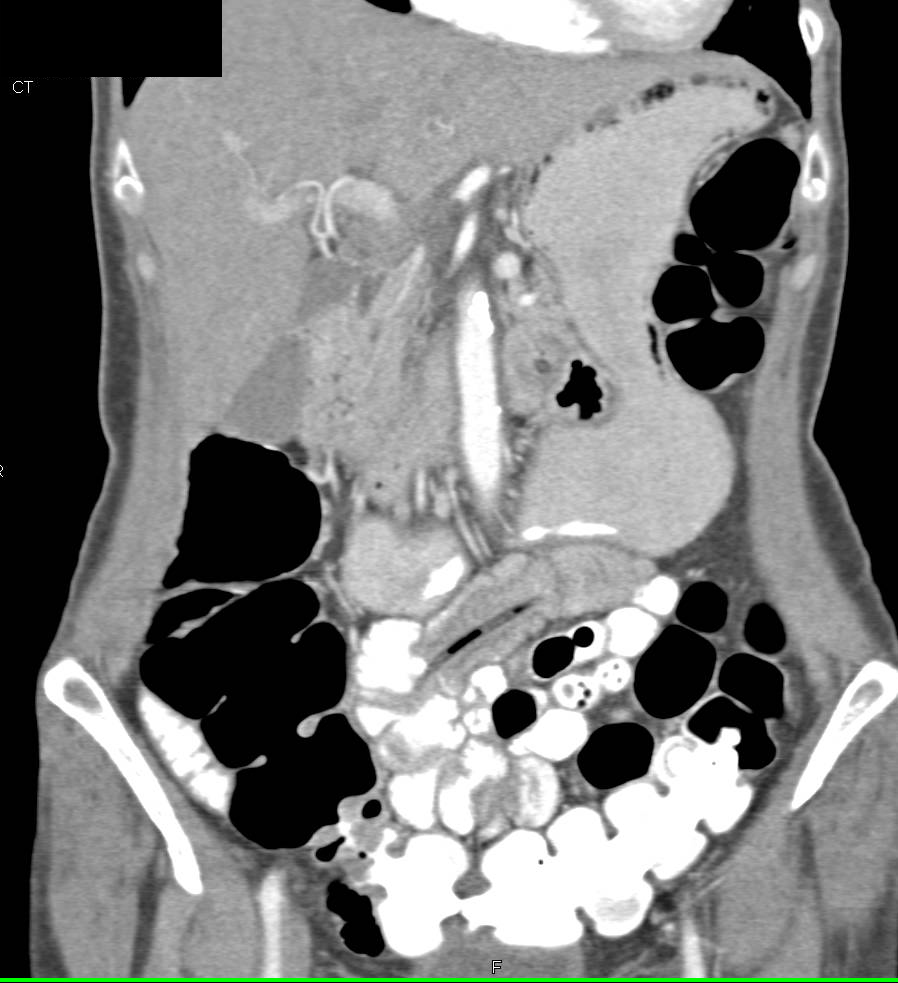 Catheter in Patients Colon - CTisus CT Scan