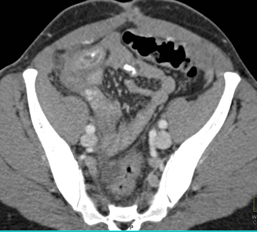 Appendicitis with Appendicolith - CTisus CT Scan