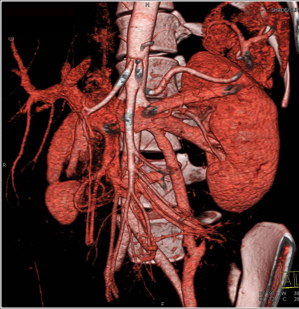 superior-mesenteric-artery-sma-syndrome-with-dilated-left-gonadal