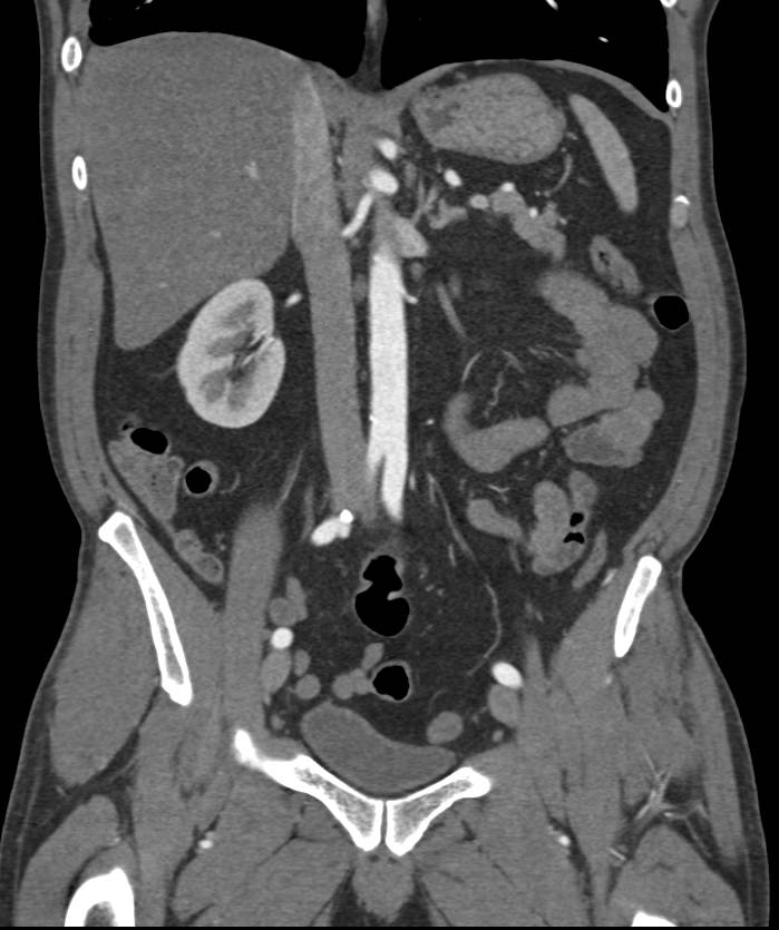 Mapping of Potential Radiation Savings When Correct Volumes Are Scanned-Not More and Not Less - CTisus CT Scan