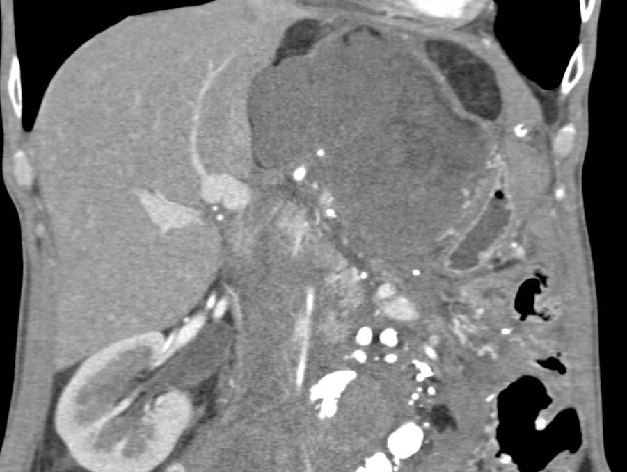 Liposarcoma - CTisus CT Scan