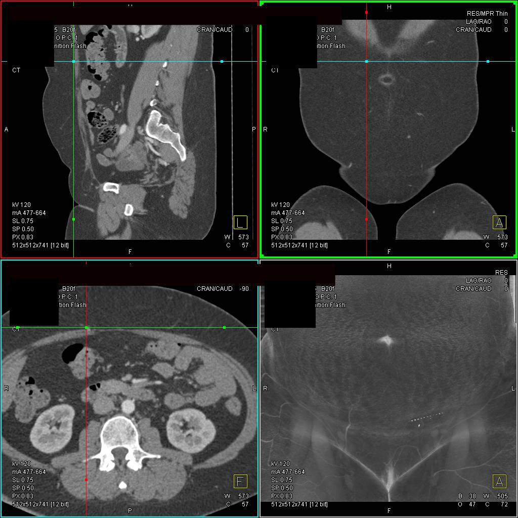 DIEP Flap Planning for Reconstructive Breast Surgery - CTisus CT Scan