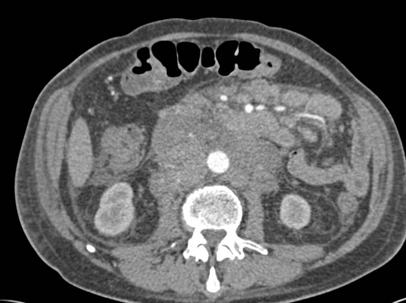 Lymphoma with Adenopathy in Para-aortic Region - CTisus CT Scan