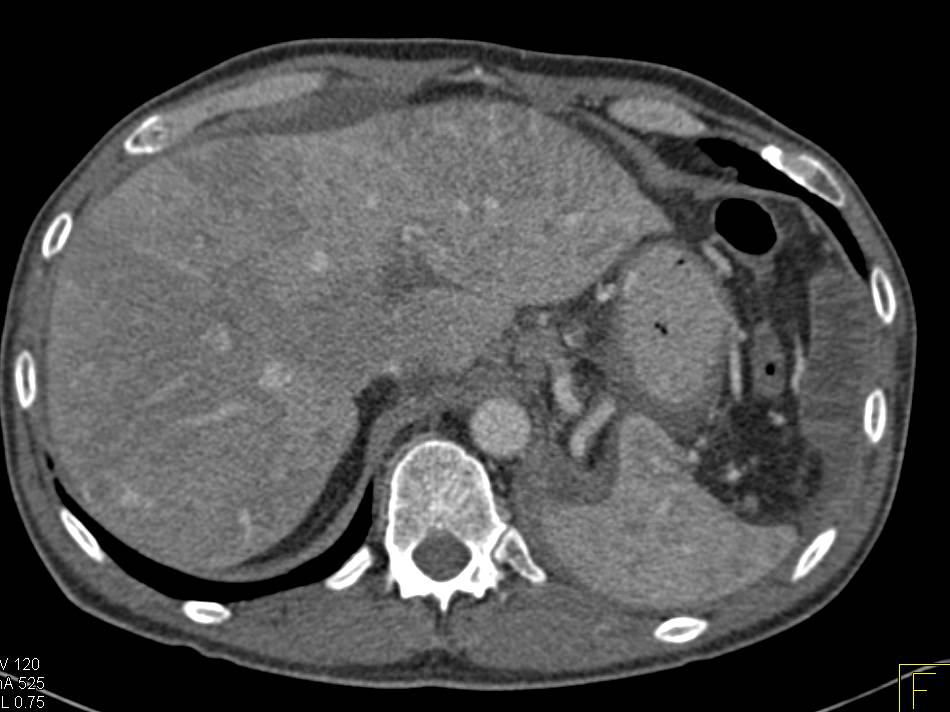 Carcinomatosis due to GI Primary - CTisus CT Scan