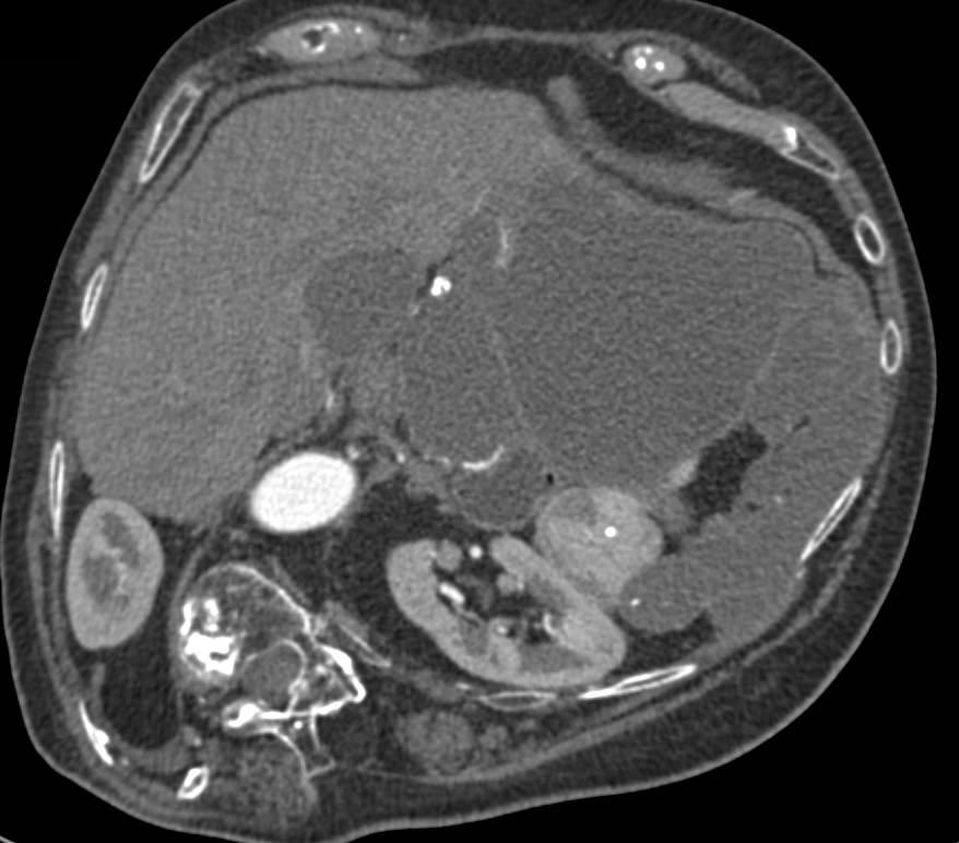 Pseudomyxoma Peritonei (PMP) with Implants in Left Upper Quadrant - CTisus CT Scan