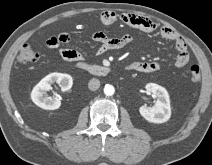 Retained Gauze Pad in Abdomen Presents as a Foreign Body Years Later - CTisus CT Scan