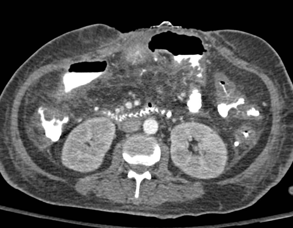 Colitis in a Post Operative Patient - CTisus CT Scan