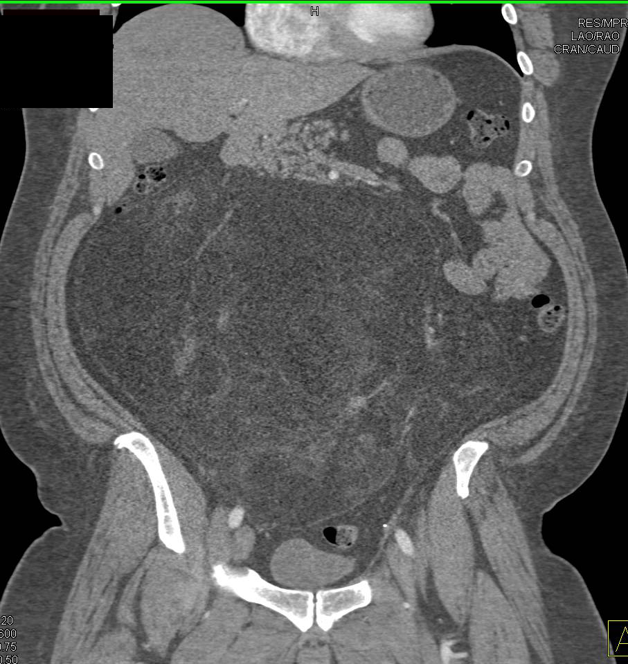 Abdominal Liposarcoma - CTisus CT Scan