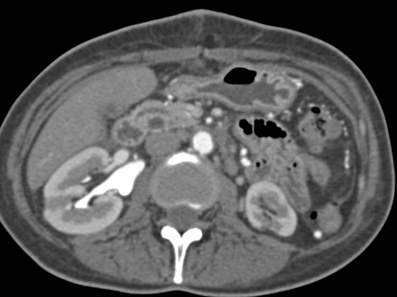 Incredible Example of Multiple Stents in Mesenteric Arteries Including Hepatic Artery, SMA - CTisus CT Scan