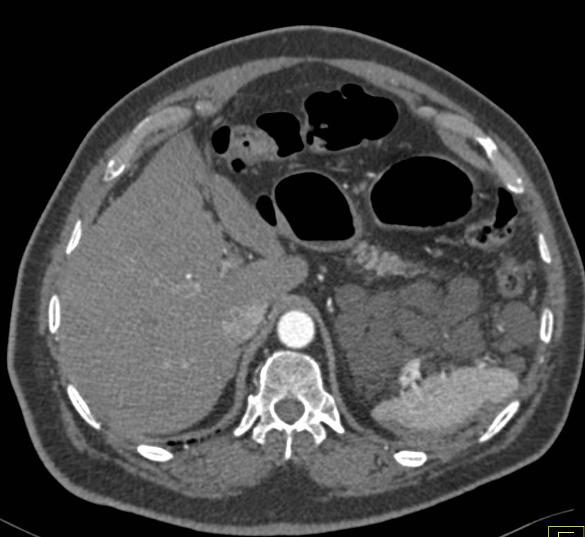 Lymphangioma - CTisus CT Scan