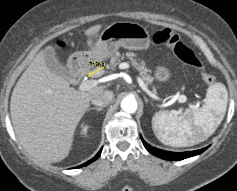 Nodes Near Head of Pancreas - CTisus CT Scan