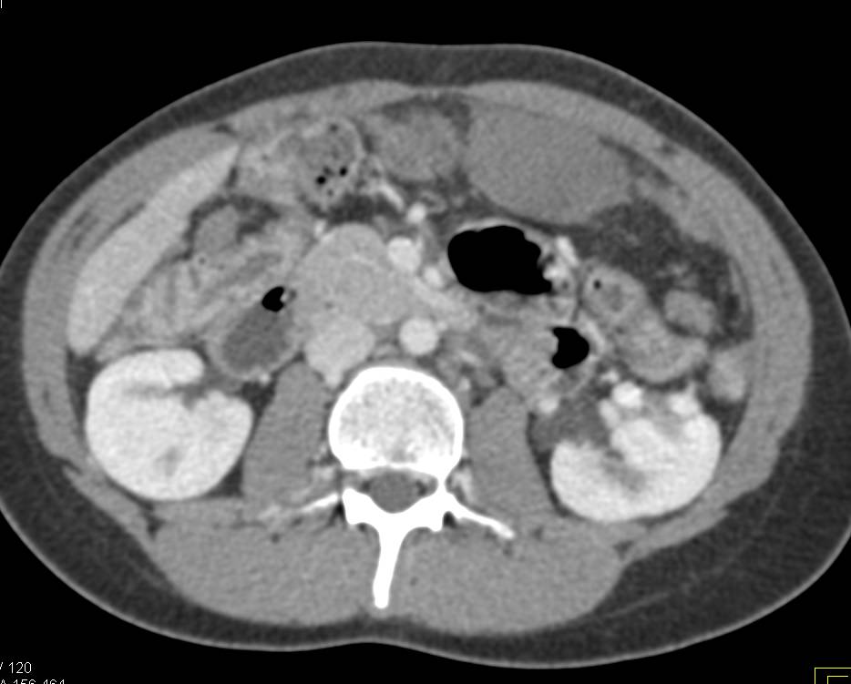 Multiple Desmoid Tumors - CTisus CT Scan