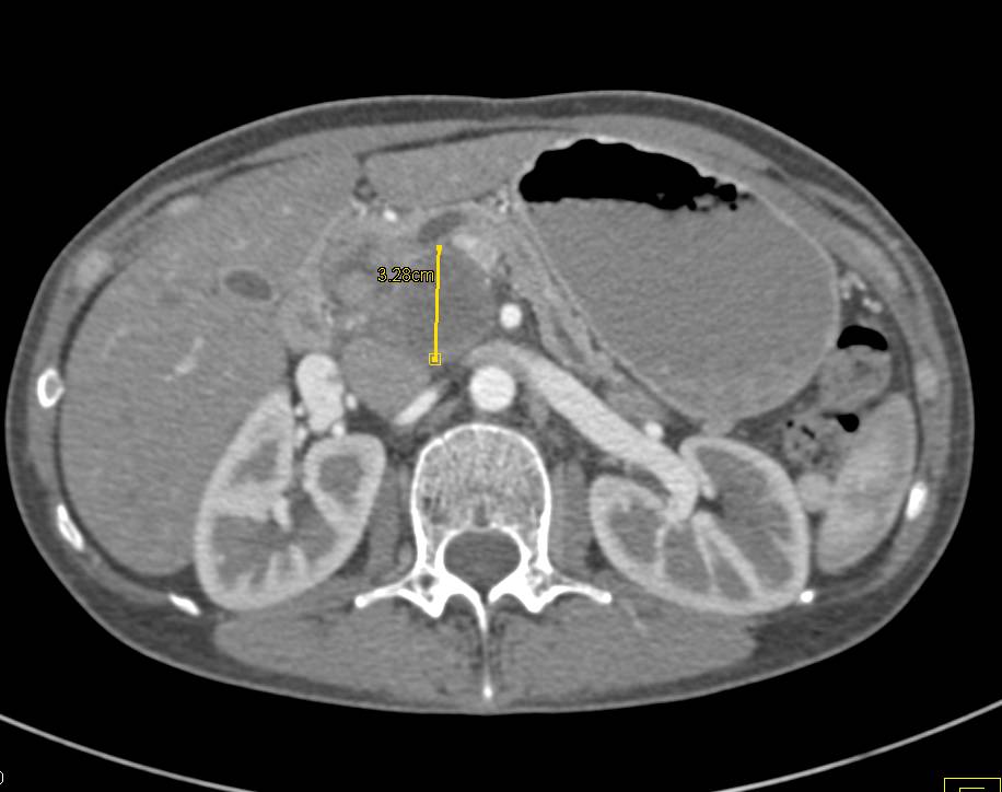 Large Node Near Head of the Pancreas Simulates A Pancreatic Mass