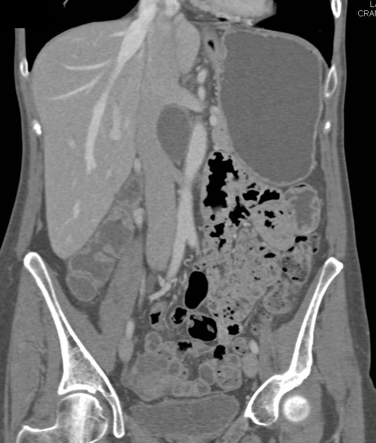 Lymphangioma - CTisus CT Scan