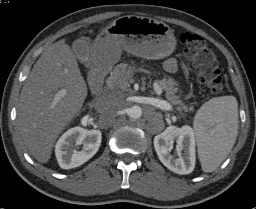 Lymphoma with Extensive Para-aortic Adenopathy - CTisus CT Scan