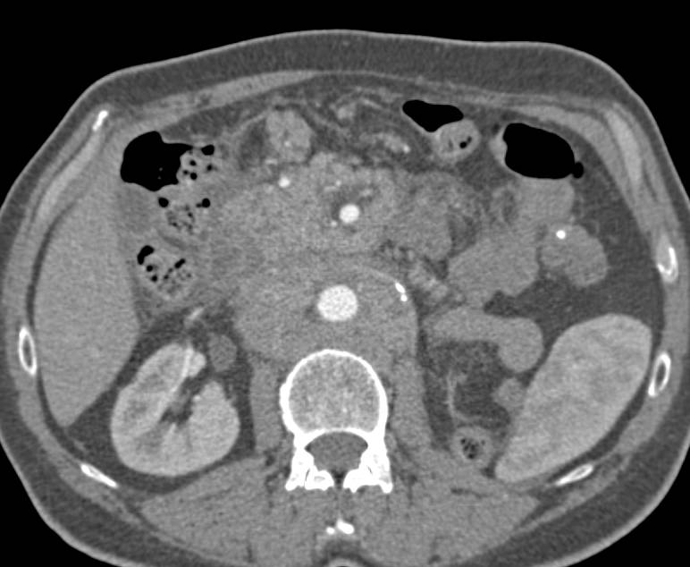 Lymphoma with Nodes Infiltrating the Mesentery - CTisus CT Scan