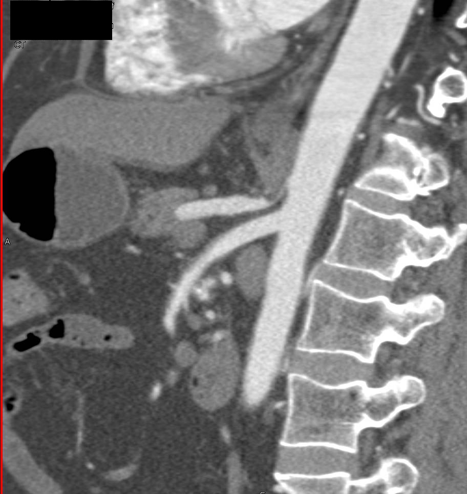 Median Arcuate Ligament Syndrome (MALS) with Dilated Gastroduodenal Artery (GDA) and Collaterals in 3D - CTisus CT Scan