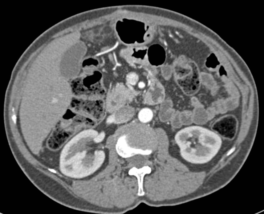 Omental Infarction Adjacent to Left Lobe of the Liver - CTisus CT Scan