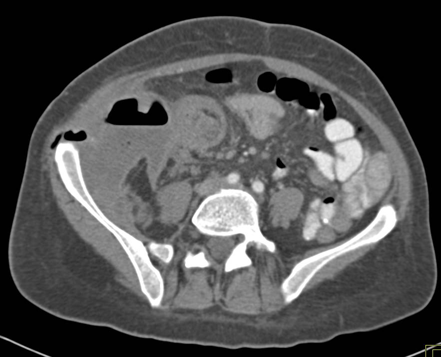 Appendiceal Abscess Involves the Abdominal Wall - CTisus CT Scan