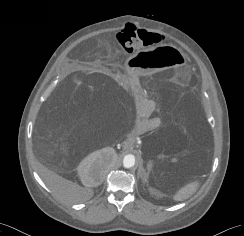 Liposarcoma - CTisus CT Scan