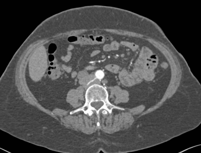 Lymphoma in Para-aortic Zone - CTisus CT Scan