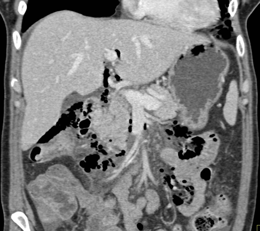 Pneumomediastinum due to Perforation of Duodenum During Endoscopic Retrograde Cholangiopancreatography (ERCP). Mild Pancreatitis and Free Fluid Also Seen - CTisus CT Scan