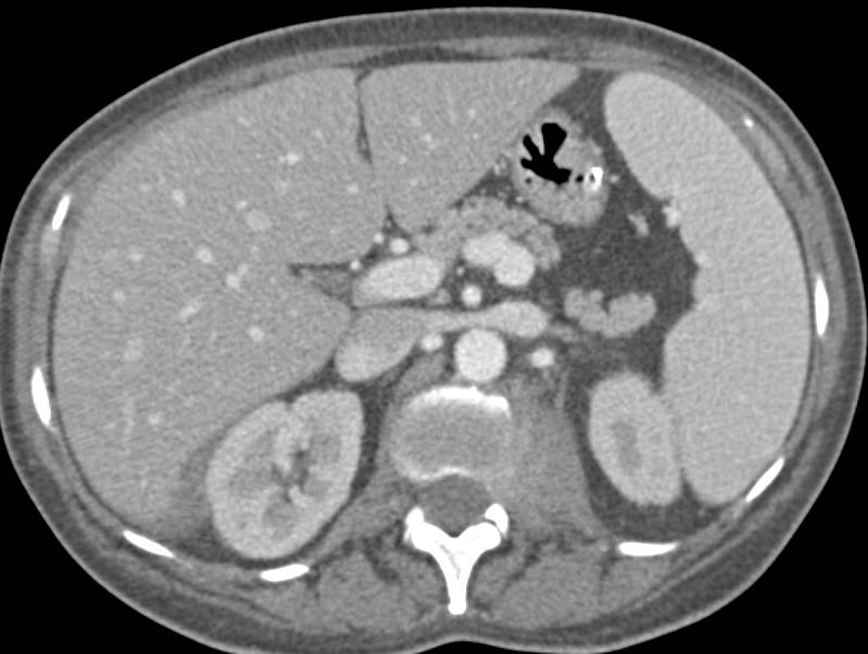 Lymphoma Infiltrates the Psoas Muscle and Involves the Skeleton with Sclerotic Lesions - CTisus CT Scan