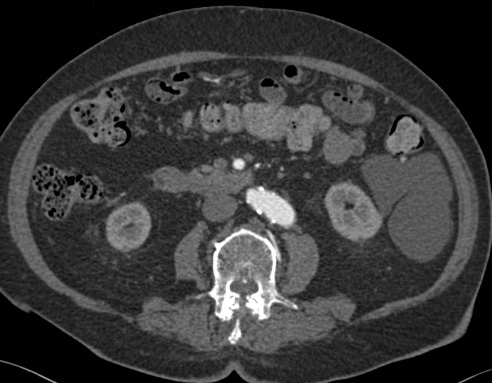 Lymphangioma - CTisus CT Scan
