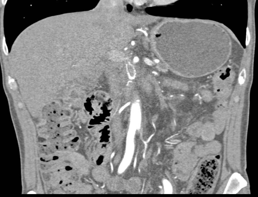 Superior Mesenteric Artery (SMA) Stent - CTisus CT Scan