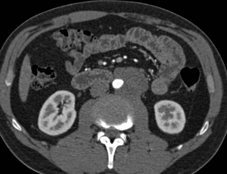 Lymphoma With Para-aortic Adenopathy - CTisus CT Scan