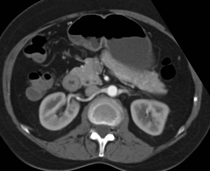 Hereditary Hemorrhagic Telangiectasia (HHT) with Multiple Arteriovenous Malformations (AVMs) in the Liver. Nice Right Sided Aortic Arch - CTisus CT Scan