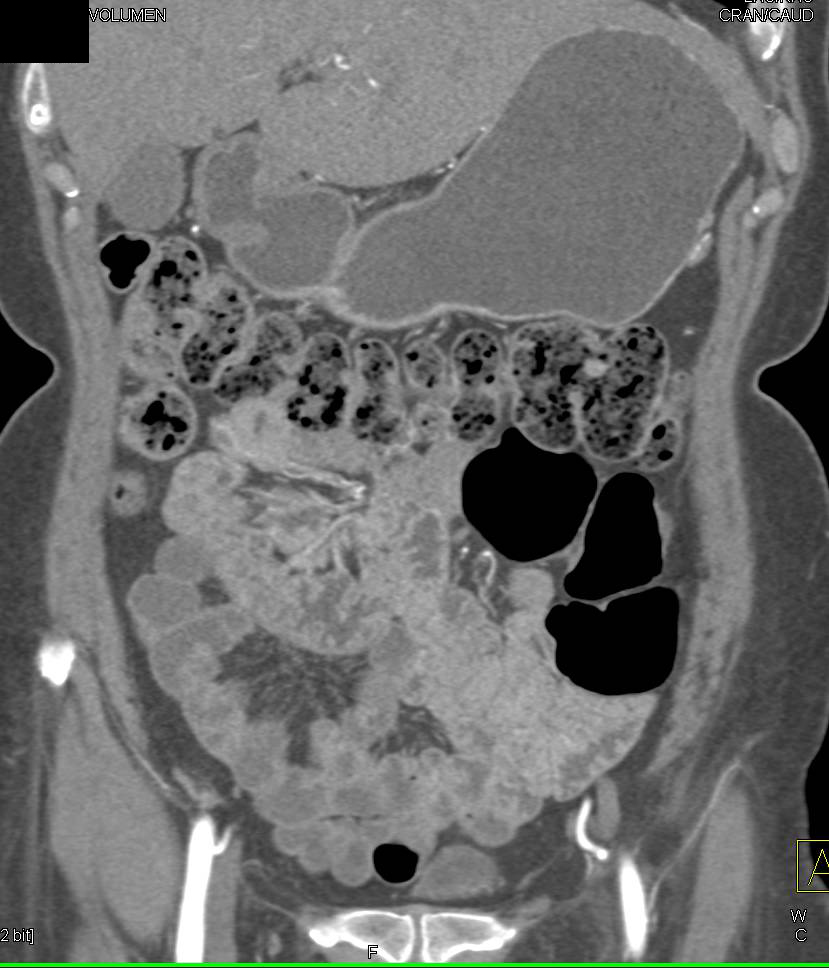 Normal CT Enteroclysis Study - CTisus CT Scan