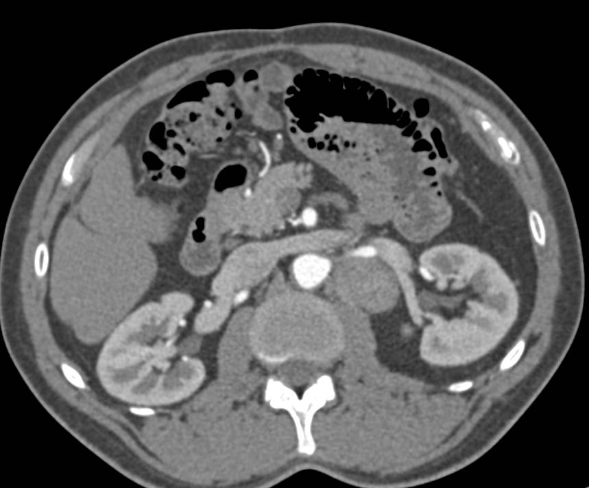 Para-aortic Adenopathy in Lymphoma - CTisus CT Scan