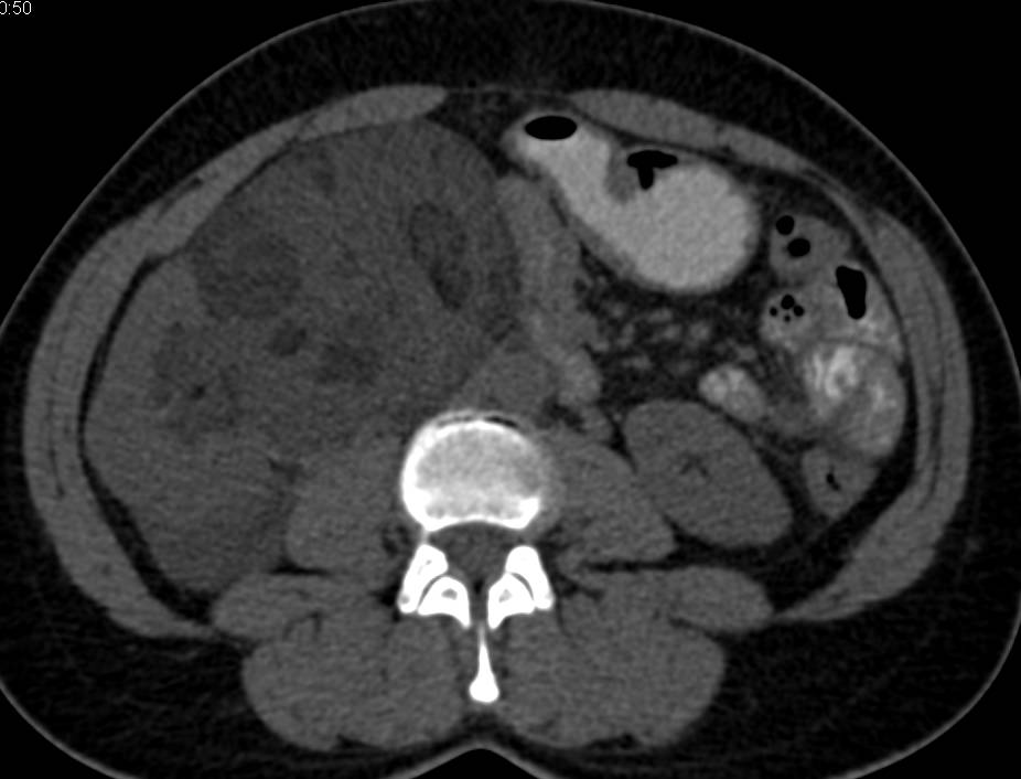 Retroperitoneal Liposarcoma - CTisus CT Scan