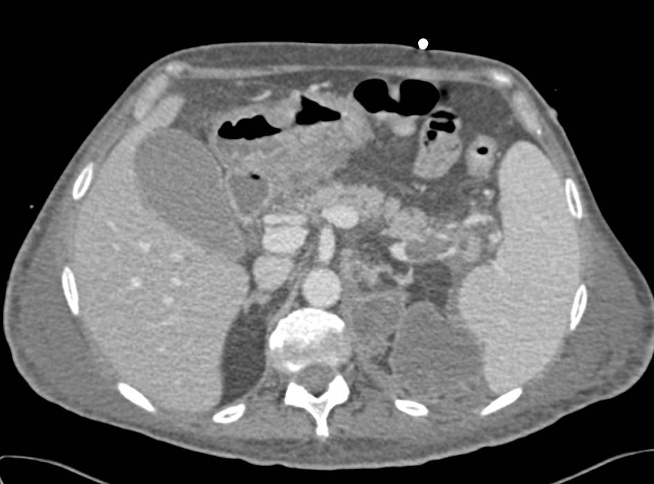 Pseudomyxoma Peritonei (PMP) and Splenic Vein Clot - CTisus CT Scan