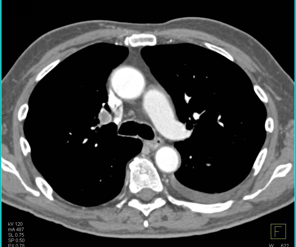 Multiple Pulmonary Emboli (PEs) in a Patient with Carcinomatosis - CTisus CT Scan