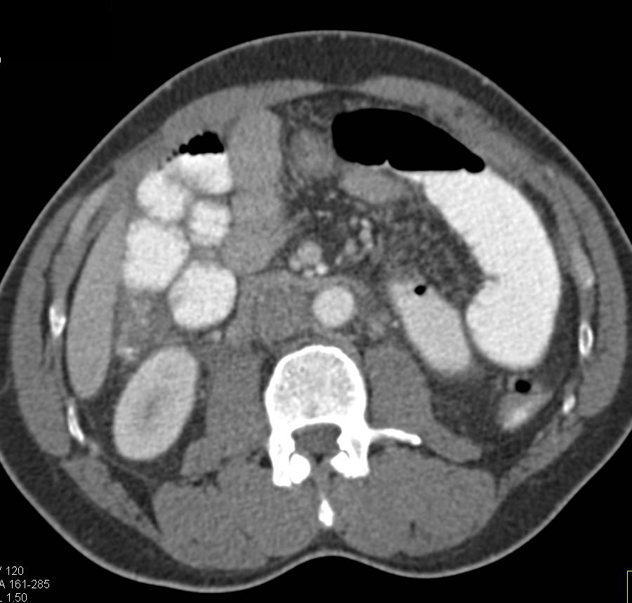 Missed Appendiceal Abscess - CTisus CT Scan