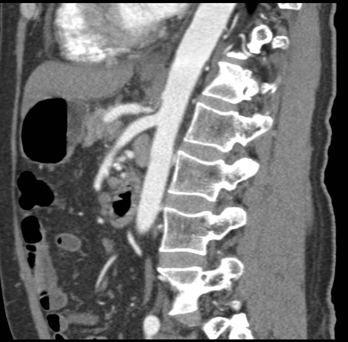 Median Arcuate Ligament Syndrome with Dilated Gastroduodenal Artery (GDA) - CTisus CT Scan