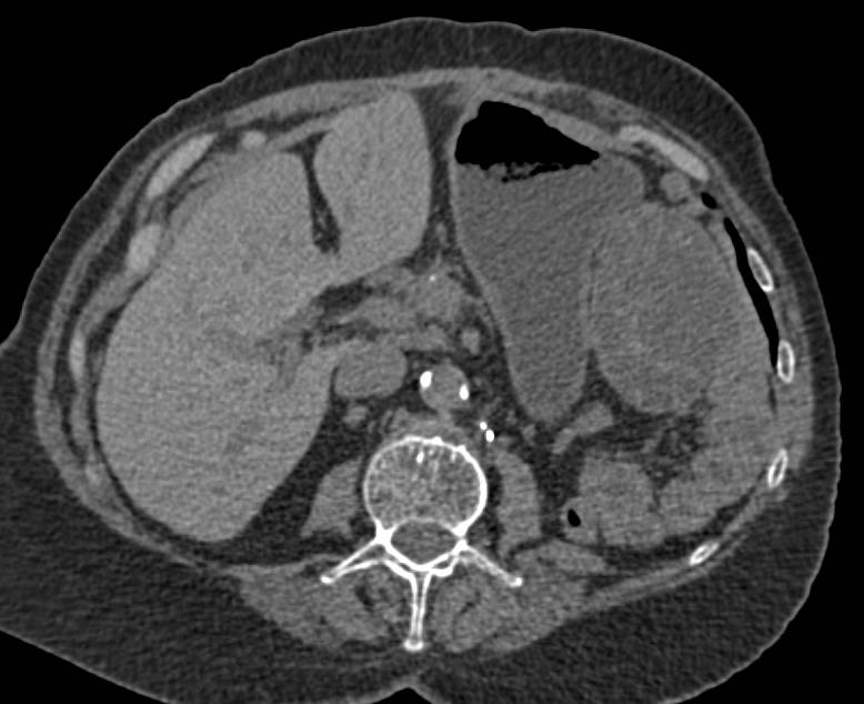 Recurrent Sarcoma in the Left Upper Quadrant - CTisus CT Scan