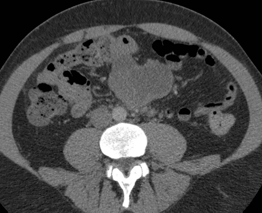 Liposarcoma in the Root of the Mesentery - CTisus CT Scan