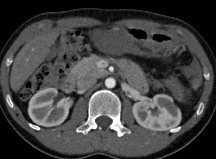 Multiple Desmoid Tumors - CTisus CT Scan