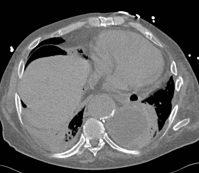 Pneumoperitoneum - CTisus CT Scan