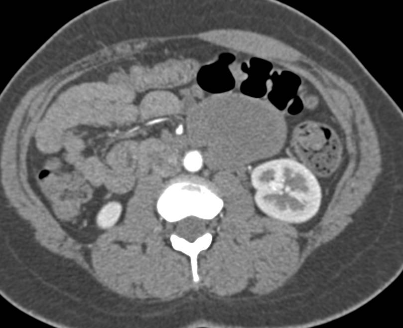 Retroperitoneal Paraganglioma - CTisus CT Scan