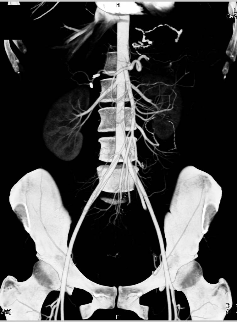 Superior Mesenteric Artery (SMA) Syndrome - CTisus CT Scan