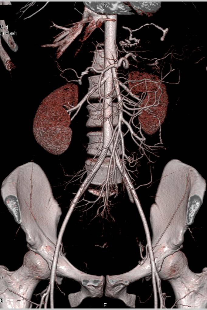 Superior Mesenteric Artery SMA Syndrome