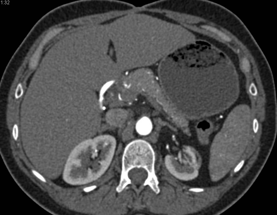 Stents in Superior Mesenteric Artery (SMA) and IMA due to Vascular Disease - CTisus CT Scan